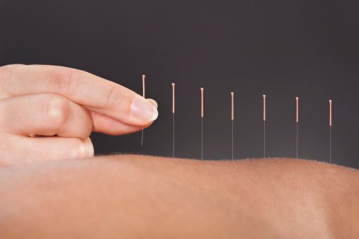 Acupuncture Is A Natural Treatment For Colitis