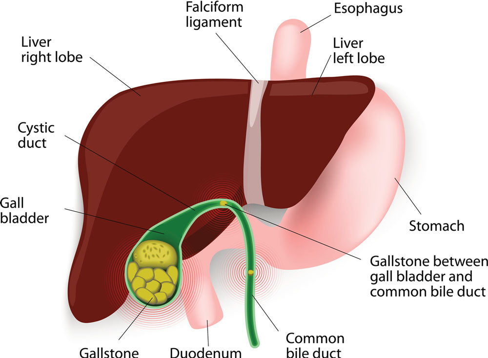 How to Get Rid of Gallstones Naturally?