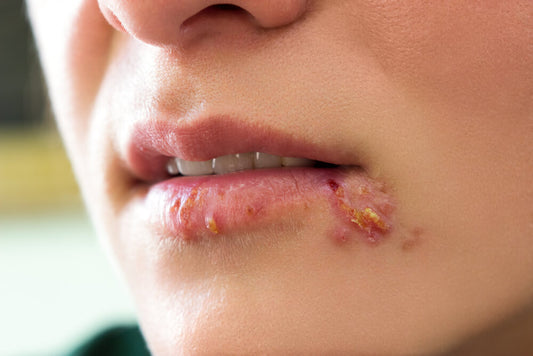 Will Aloe Vera Help With Cold Sores? Can You Put It on Your Lips?