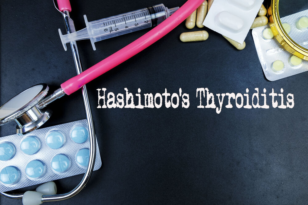 Hashimoto’s Thyroiditis: An Overview of an Autoimmune Disease