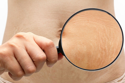 How to Get Rid of Stretch Marks?